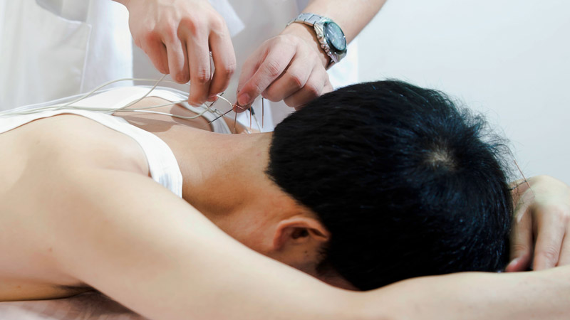 Acupuncture